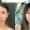 EndoscopicBrowLift-1400x788